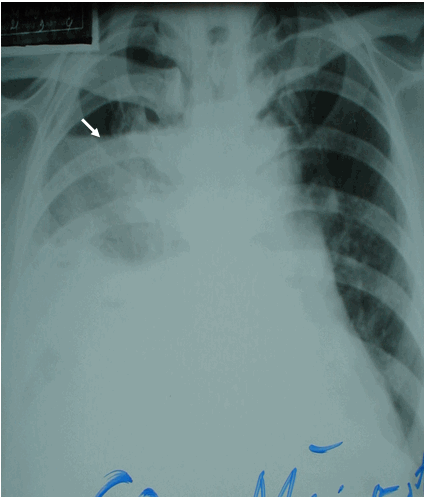 Hình ảnh tràn mủ tràn khí màng phổi phải trên phim phổi thẳng ở bệnh nhân nam, 50 tuổi  Viêm mủ màng phổi sau viêm phổi