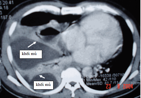 Hình ảnh tràn mủ màng phổi bên phải đã bị vách hoá (mũi tên trắng) trên phim chụp CT ngực ở cửa sổ trung thất (cùng bệnh nhân)