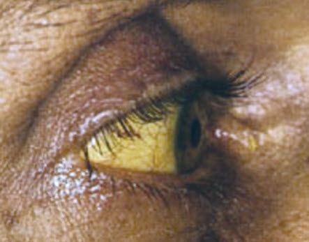 Củng mắt vàng trong hội chứng hoàng đảm