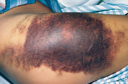 Mảng xuất huyết ở bệnh nhân hemophilia