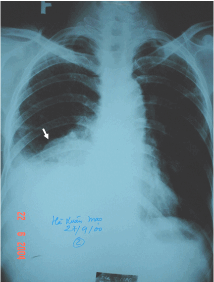 Hình ảnh K phổi thể trung tâm gây xẹp phổi kéo tim sang phải & tràn dịch màng phổi cùng bên tổn thương