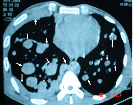Hình ảnh ung thư (K) phổi & màng phổi thứ phát dạng thả bóng dày đặc với các kích thước khác nhau trên phim chụp cắt lớp vi tính ngực