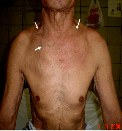 Hình ảnh phù áo khoác & tuần hoàn bàng hệ ở ngực trong hội chứng trung thất (hố thượng đòn 2 bên đầy hai mũi tên trắng giữa. Tuần hoàn bàng hệ ở ngực - mũi tên trắng dưới cùng)