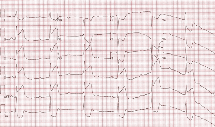 Nhồi múa cơ tim thành dưới với block AV cấp ba và chậm nhịp thoát vùng bộ nối