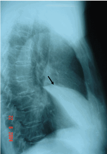 Hình ảnh viêm thuỳ giữa phổi phải trên phim chụp nghiêng phải