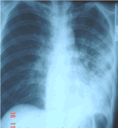 Hình ảnh viêm nửa dưới phổi trái và xẹp một phần phổi cùng bên do sặc dầu