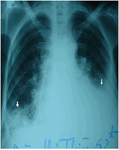 Hình ảnh viêm phổi có tràn dịch màng phổi hai bên trên phim phổi