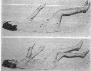 Nghiệm pháp Barré chi trên kết hợp với nghiệm pháp Mingazini theo Strumpel (Liệt tay chân trái)