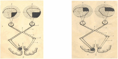 Bán manh ¼ dưới (trái) ¼ trên.