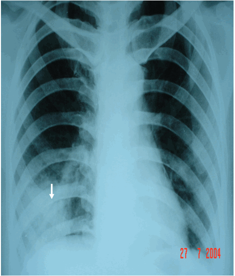 Hình ảnh áp xe đáy phổi phải có dạng đám mờ trên phim phổi thẳng ở bệnh nhân nữ, 29 tuổi  Viêm phổi áp xe hoá