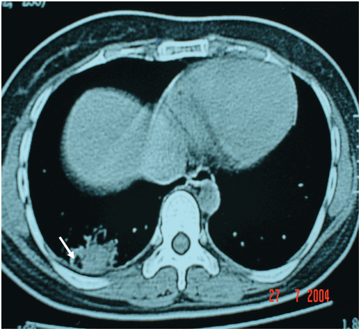 Ổ áp xe ở đáy phổi phải dạng đám mờ trên phim thường đã được phát hiện có ổ hoại tử rõ trên phim chụp CT ngực ở cùng bệnh nhân - Viêm phổi áp xe hoá