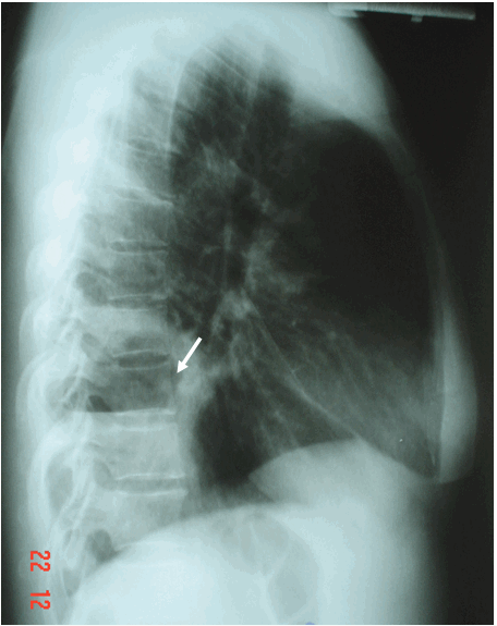 Hình ảnh ổ áp xe phổi phải có mức nước mức hơi trên phim phổi nghiêng phải ở bệnh nhân nữ, 62 tuổi  Áp xe phổi phải 