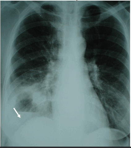 Hình ảnh ổ áp xe phổi phải có mức nước mức hơi trên phim phổi thẳng ở bệnh nhân nữ, 82 tuổi - Áp xe phổi phải 
