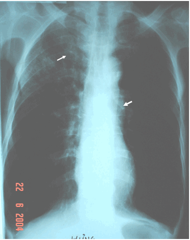 Hình ảnh phổi sáng giãn phế nang hai bên, tim thõng hình giọt nước, cung động mạch phổi phồng, vùng đỉnh phổi & hạ đòn bên phải mờ trong bệnh phổi tắc nghẽn mạn tính (COPD)