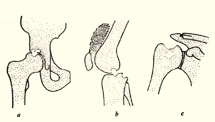 Viêm sụn khớp do lao