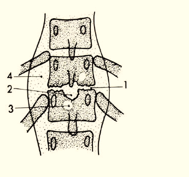 Lao cột sống ngực