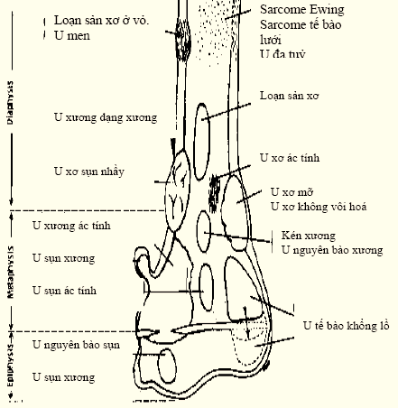 Các vị trí u xương thường gặp