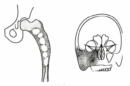 Loạn sản xơ xương