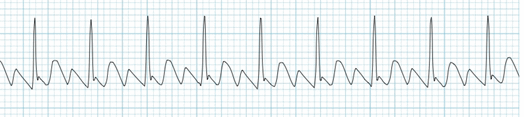 phức bộ QRS nhịp hẹp