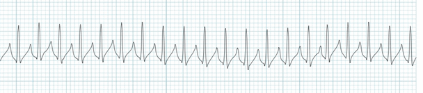 phức bộ QRS nhịp hẹp