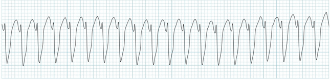 phức bộ QRS rộng