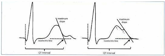 Khoảng QT được xác định từ đầu của phức bộ QRS đến cuối sóng T