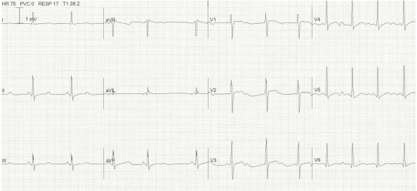 QTc 500 ms với sóng U nổi bật trong đạo trình trước tim do hạ kali máu (K 1.9)