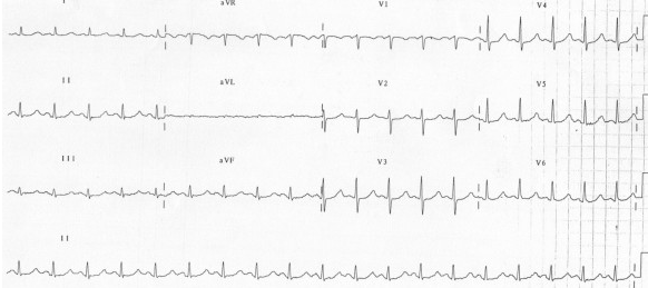 QTC 510 ms thứ phát do hypomagnesaemia