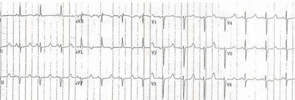 QTC 510ms do hạ calci máu