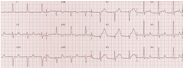 QTC 495 ms do hyperacute MI