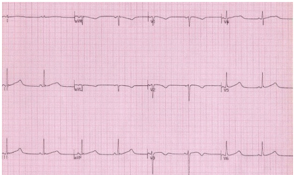 QTc 550ms do hội chứng QT kéo dài bẩm sinh