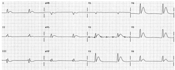 Rút ngắn thời gian QTc (260ms) do tăng calci máu