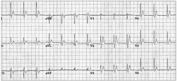 Ngắn QTc (280ms) với sóng T cao, lên đến đỉnh điểm do hội chứng QT ngắn bẩm sinh