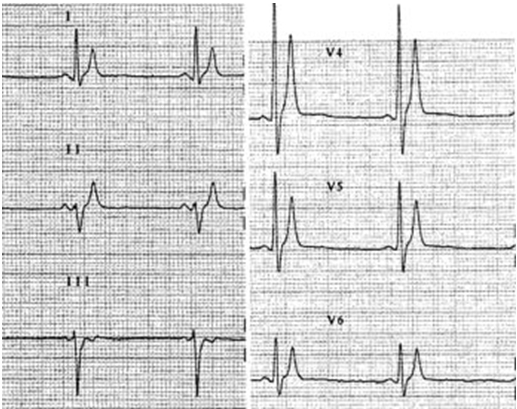 Ngắn QT (<300ms) với sóng T đạt đỉnh trong hai bệnh nhân SQTS