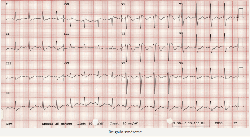 Brugada syndrome