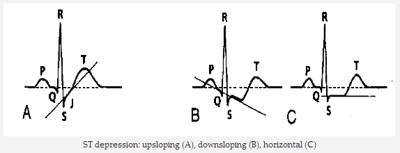 ST chênh xuống: upsloping (A), downsloping (B), horizontal (ngang) (C)