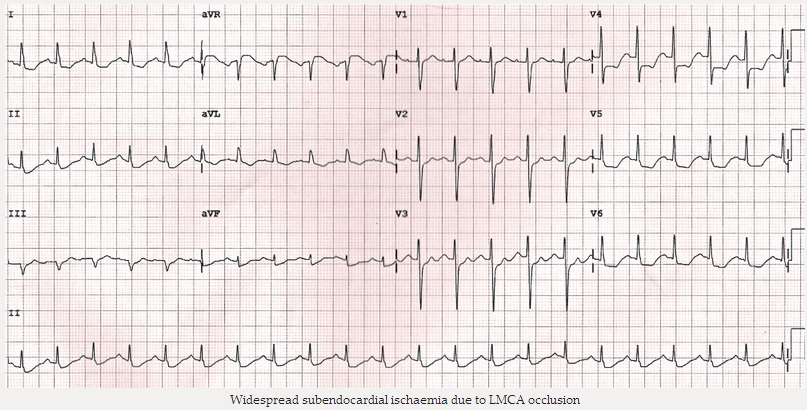 Thiếu máu cục bộ dưới màng trong tim (subendocardial) do tắc LMCA