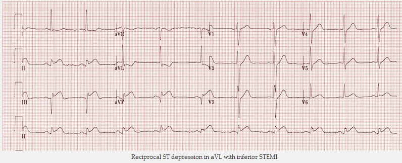 Đối ứng ST giảm xuống ở aVL với STEMI thành dưới