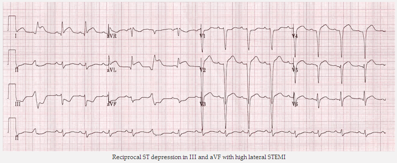 Đối ứng ST giảm xuống trong III và aVF với STEMI thành bên cao