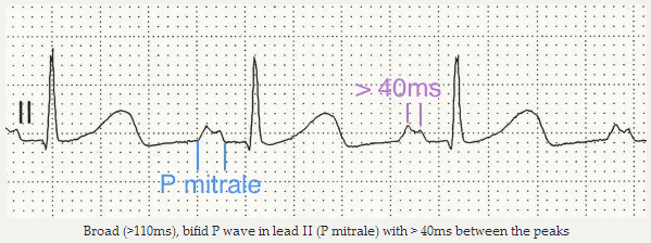 Sóng P rộng (> 110ms), nứt đôi P trong DII (P mitrale) với > 40ms giữa các đỉnh