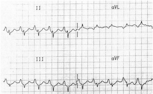 Sự hiện diện của sóng P cao đạt đỉnh trong DII là một dấu hiệu của sự mở rộng tâm nhĩ phải, thường là do tăng áp phổi  (ví dụ bệnh hô hấp mãn tính)