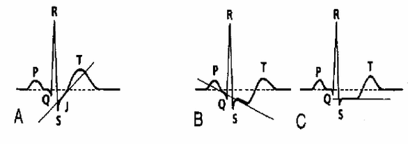 Độ dốc đi xuống của ST theo sau là sóng T đảo ngược, hai pha