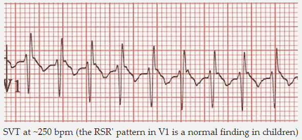 SVT với nhịp ~ 250 bpm (hình RSR' trong V1 là một phát hiện bình thường ở trẻ em)