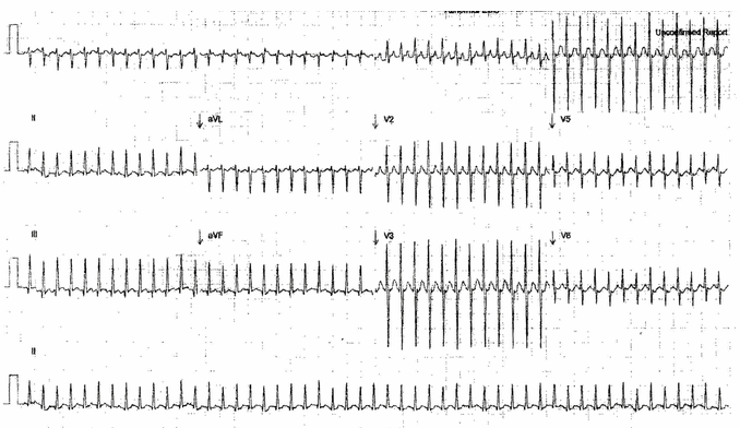  Nhịp tim nhanh phức bộ QRS hẹp trong một cậu bé 12 ngày