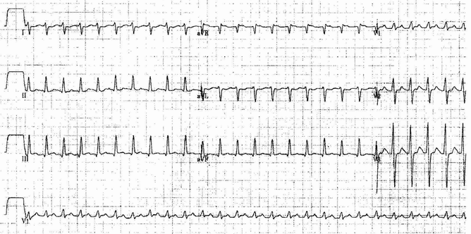 Nhịp tim nhanh phức bộ hẹp trong một cậu bé 12 ngày - tốc độ giấy 50 mm / giây