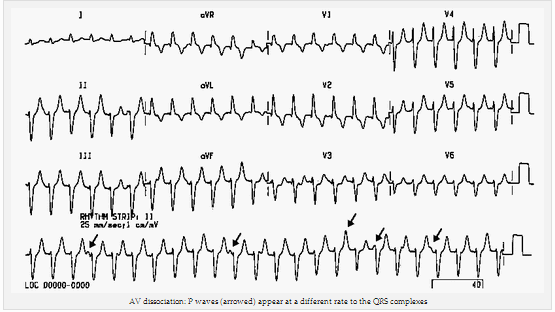 Phân ly AV: Sóng P (mũi tên) xuất hiện với một tốc độ khác nhau đến các phức bộ QRS
