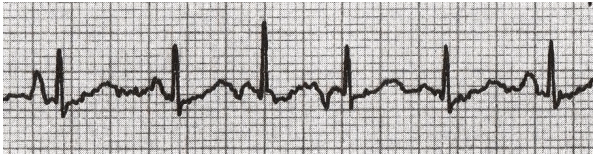 Nếu ≥ 3 hình thái sóng P khác nhau được nhìn thấy và tỷ lệ này ≥ 100, nhịp tim nhanh nhĩ đa ổ (MAT) sẽ được chẩn đoán