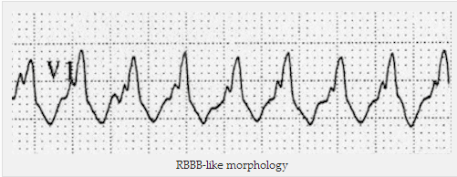 Hình thái học với RBBB