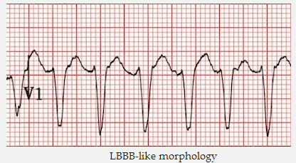 Hình thái học với LBBB