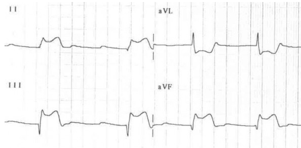 Sóng Q sâu (II, III, aVF) với ST chênh lên do MI cấp